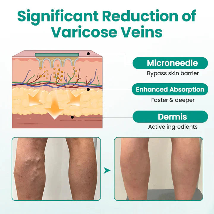 Turmeric Vericose Vein Patch (Pack of 20)